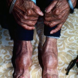 Vanishing Tribes Of Burma: Bound Feet